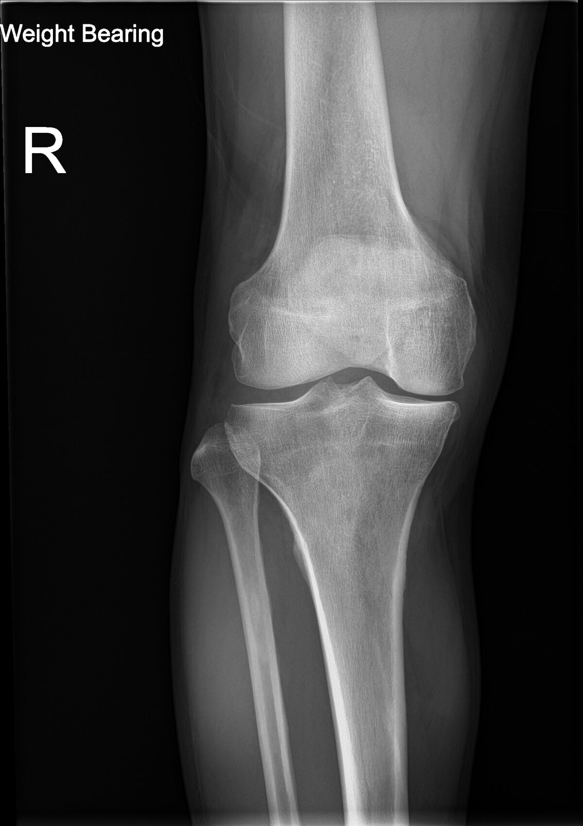 Chronic Refractory Osteomyelitis (Bone Infection)